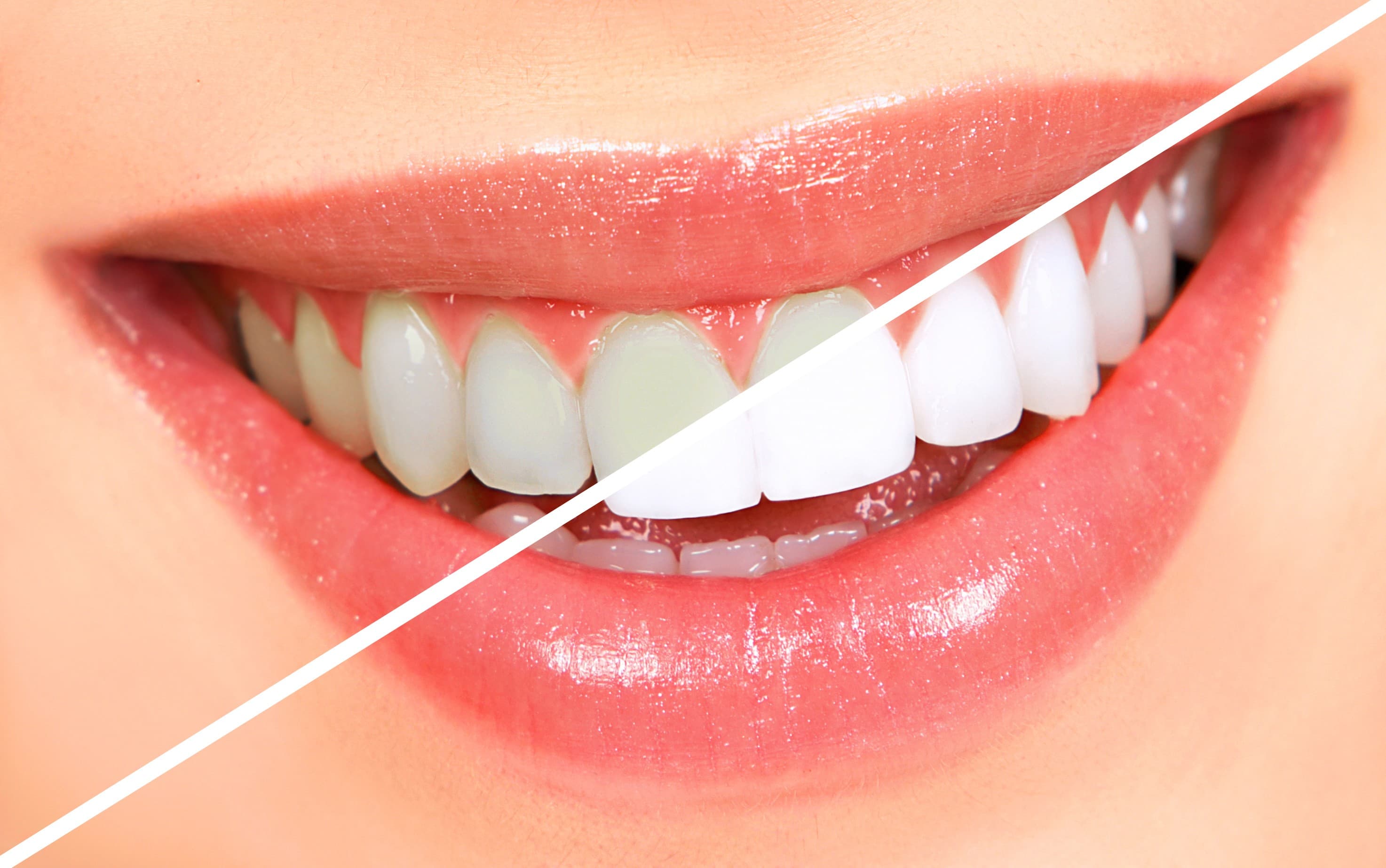 Teeth whitening: Methods and safety tips