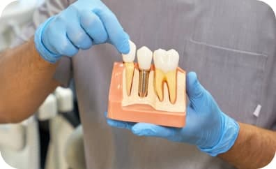 Dental Implant