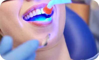 Composite Veneers